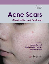 Acne Scars : Classification and Treatment - Antonella Tosti