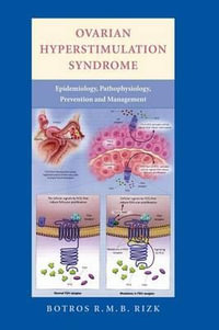 Ovarian Hyperstimulation Syndrome : Epidemiology, Pathophysiology, Prevention and Management - Botros R. M. B. Rizk