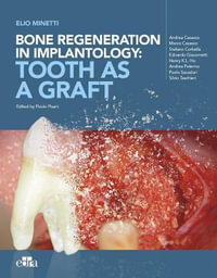 Bone regeneration in implantology - tooth as a graft - Elio Minetti