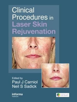 Clinical Procedures in Laser Skin Rejuvenation : Series in Cosmetic and Laser Therapy - Paul Carniol