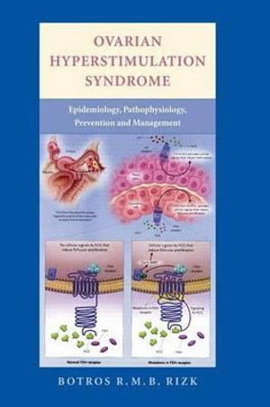 Ovarian Hyperstimulation Syndrome : Epidemiology, Pathophysiology, Prevention and Management - Botros R. M. B. Rizk