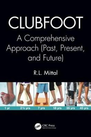 Clubfoot : A Comprehensive Approach (Past, Present, and Future) - R. L. Mittal