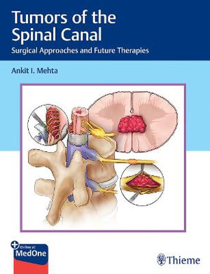 Tumors of the Spinal Canal : Surgical Approaches and Future Therapies - Ankit I. Mehta