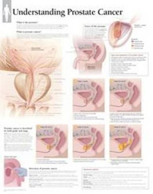 Understanding Prostate Cancer Laminated Poster - Scientific Publishing