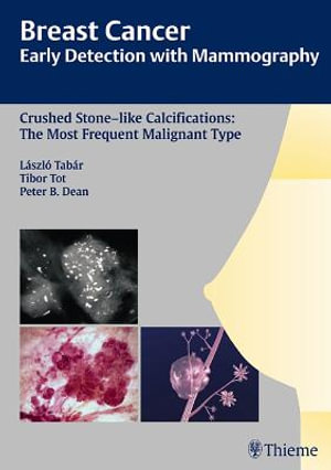 Breast Cancer: Early Detection with Mammography : Crushed Stone-like Calcifications: The Most Frequent Malignant Type - Laszlo Tabar