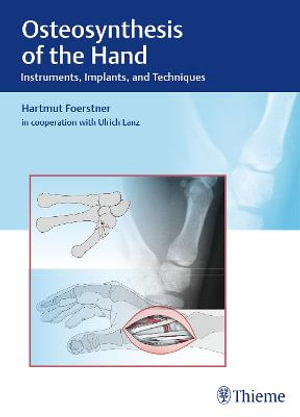 Osteosynthesis of the Hand : Instruments, Implants, and Techniques - Hartmut Foerstner